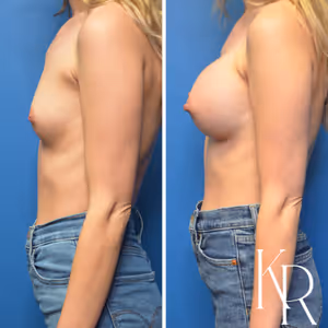 Breast augmentation before and after photo, front view