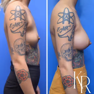 Breast augmentation before and after photo, side view