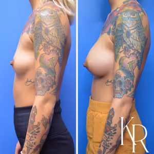 Breast augmentation before and after photo, side view