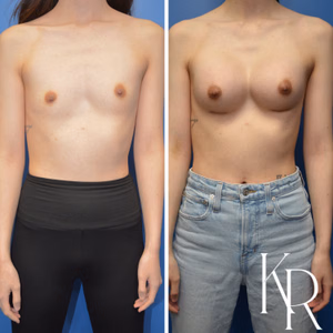 Breast augmentation before and after photo, front view