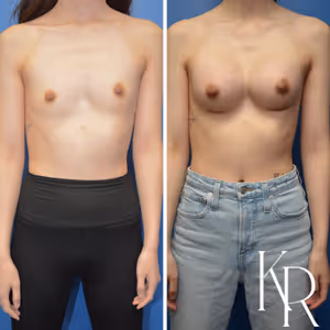 Breast augmentation before and after photo, front view