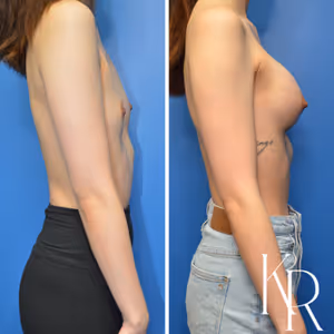Breast augmentation before and after photo, side view