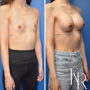 Breast augmentation before and after photo, front view