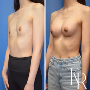 Breast augmentation before and after photo, front view