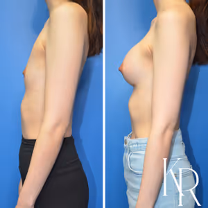 Breast augmentation before and after photo, side view