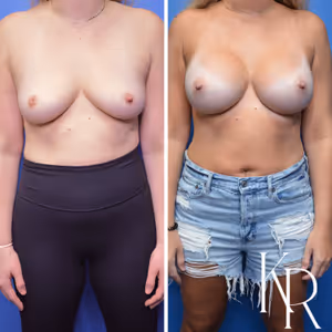 Breast augmentation before and after photo, front view