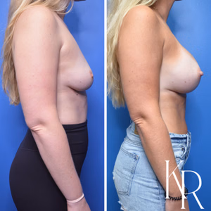 Breast augmentation before and after photo, side view