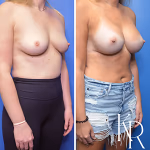 Breast augmentation before and after photo, front view