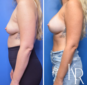 Breast augmentation before and after photo, side view