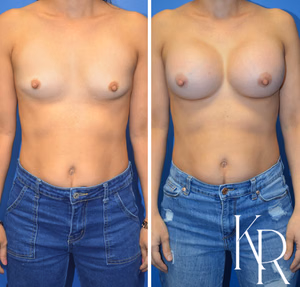 Breast augmentation before and after photo, front view