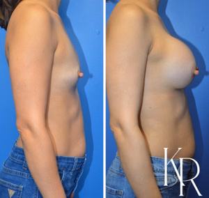Breast augmentation before and after photo, side view