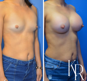 Breast augmentation before and after photo, front view