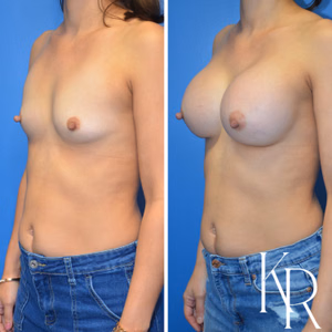 Breast augmentation before and after photo, front view