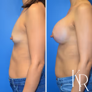 Breast augmentation before and after photo, side view