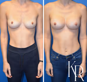 Breast augmentation before and after photo, front view