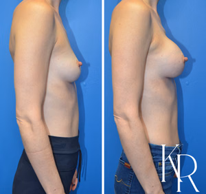 Breast augmentation before and after photo, side view