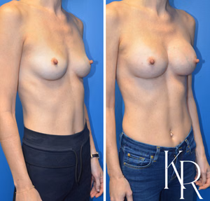 Breast augmentation before and after photo, front view