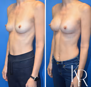 Breast augmentation before and after photo, side view