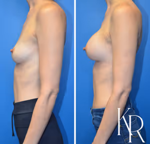 Breast augmentation before and after photo, front view