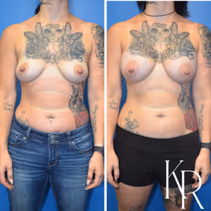 Breast augmentation before and after photo, front view