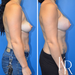 Breast augmentation before and after photo, side view