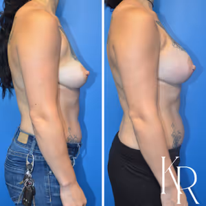 Breast augmentation before and after photo, side view
