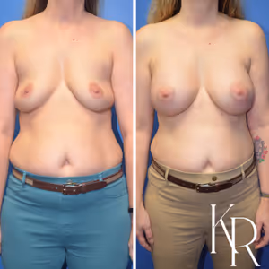 Breast augmentation before and after photo, side view