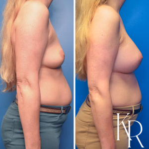 Breast augmentation before and after photo, side view