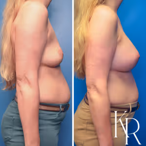 Breast augmentation before and after photo, side view