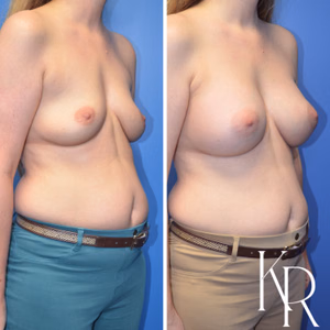 Breast augmentation before and after photo, front view
