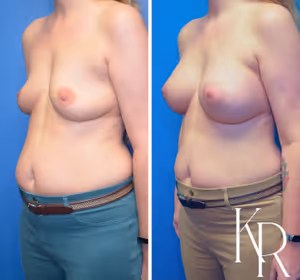 Breast augmentation before and after photo, front view