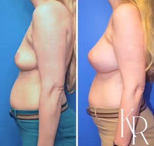 Breast augmentation before and after photo, side view