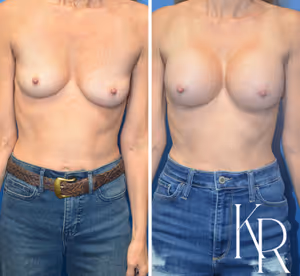 Breast augmentation before and after photo, front view