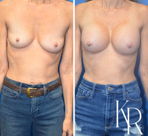 Breast augmentation before and after photo, front view