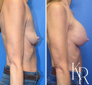 Breast augmentation before and after photo, side view