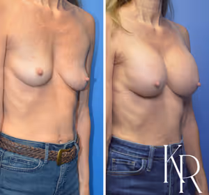 Breast augmentation before and after photo, front view