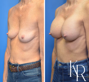 Breast augmentation before and after photo, front view