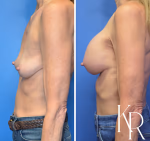Breast augmentation before and after photo, side view