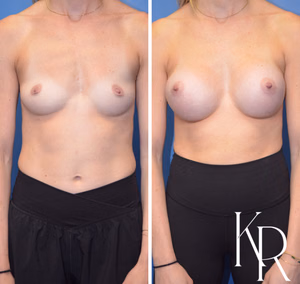 Breast augmentation before and after photo, front view