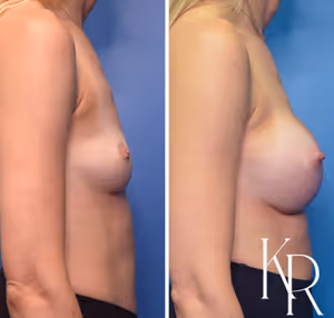 Breast augmentation before and after photo, side view
