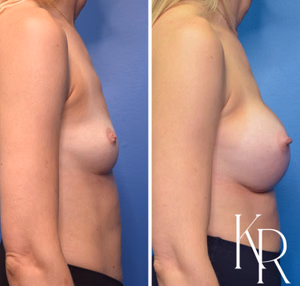 Breast augmentation before and after photo, side view