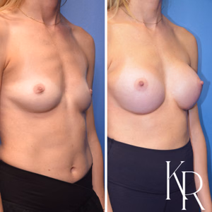 Breast augmentation before and after photo, front view
