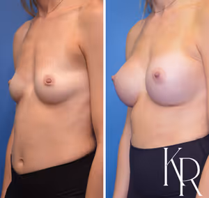 Breast augmentation before and after photo, front view