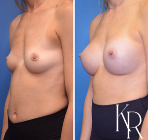 Breast augmentation before and after photo, front view