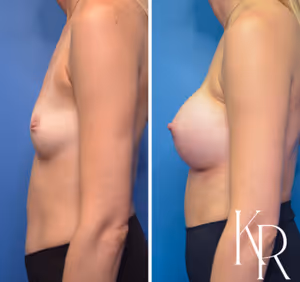 Breast augmentation before and after photo, side view