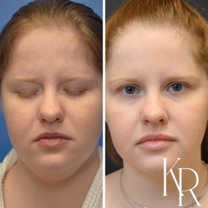 Submental liposuction before and after photo, close-up view