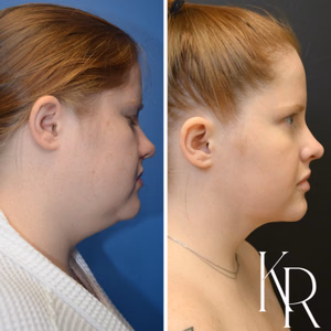 Submental liposuction before and after photo, close-up view