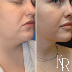 Submental liposuction before and after photo, close-up view