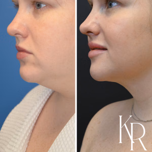 Submental liposuction before and after photo, close-up view