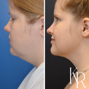 Submental liposuction before and after photo, close-up view